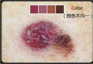 想把脸上的痣去掉去医院哪个科,脸上危险三角区的痣可以去掉吗