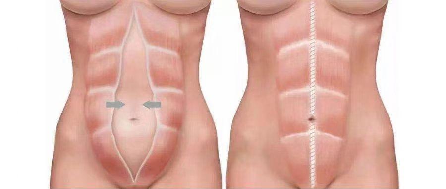 产后妈妈腹部肥胖，小心“腹直肌分离”在作怪