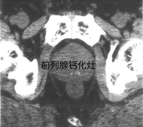 前列腺钙化灶可以用冲击波治疗吗,前列腺钙化灶尿频尿痛怎么治疗