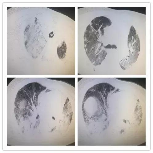 呼吸困难为主要症状的住院大病历,病人出现呼吸困难症状