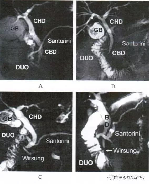 副胰管与主胰管图谱,主胰管型和分支胰管型如何鉴别