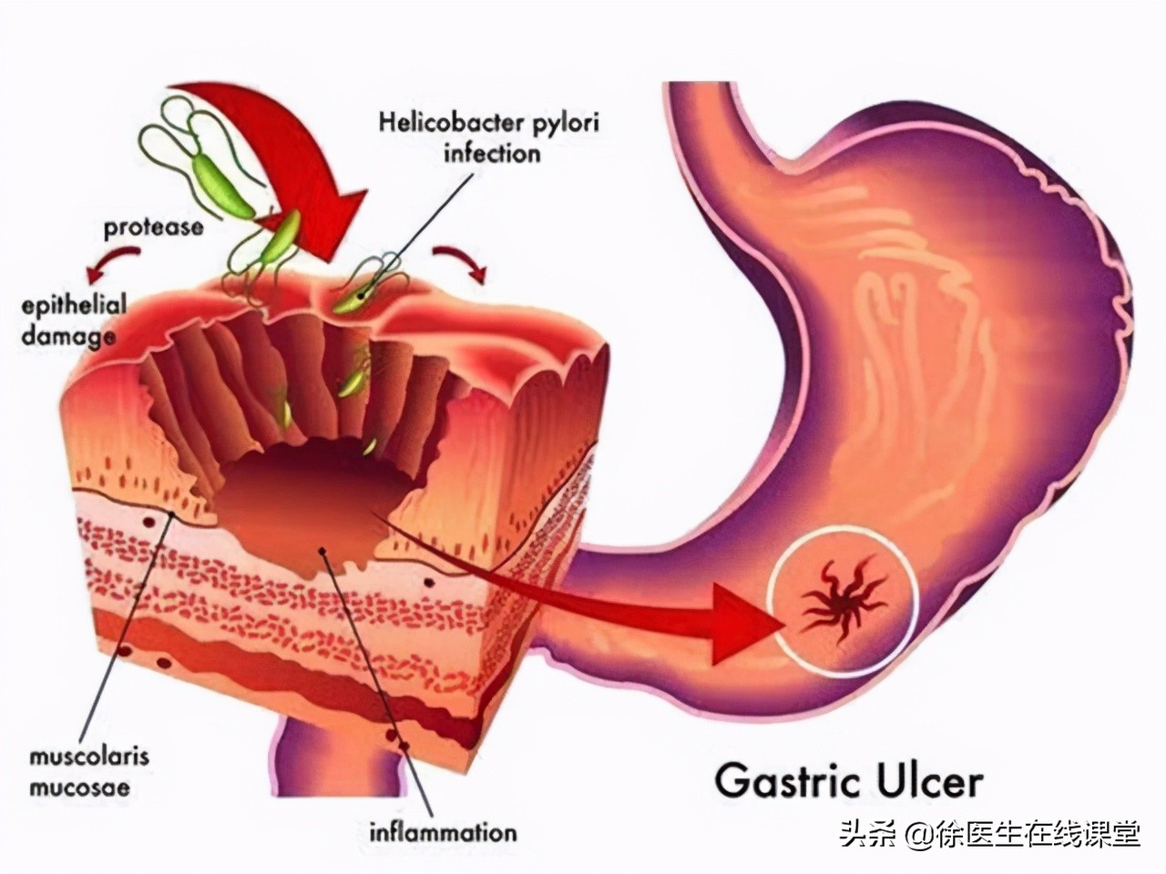 怎么根治幽门螺杆菌引起的胃病,幽门螺杆菌胃病可以治好吗