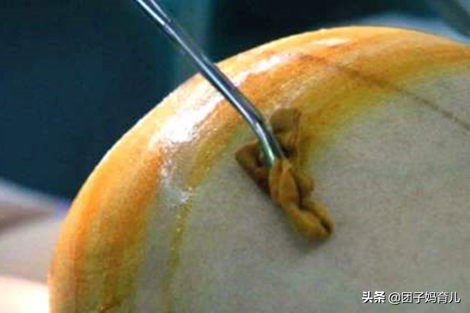 剖腹产生娃也能改善体质吗,剖腹产半麻醉生孩子的真实流程