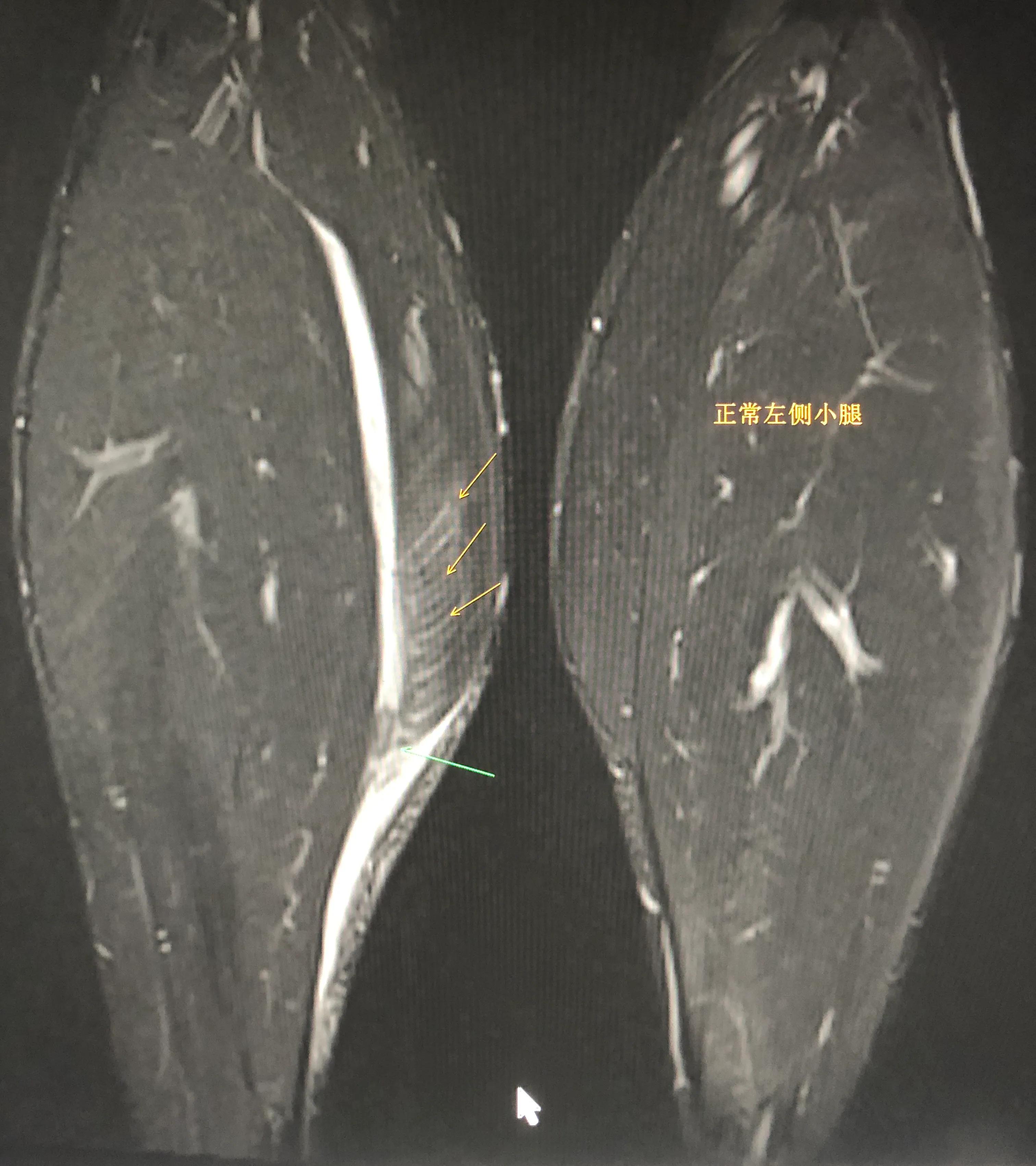 网球腿,网球肘肌腱撕裂