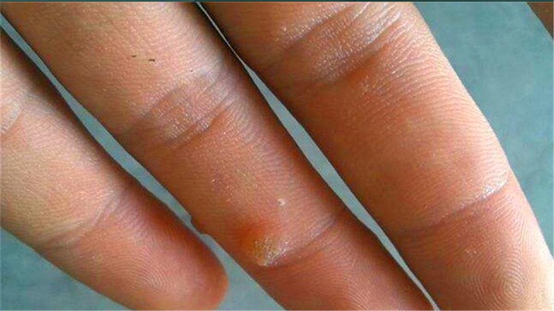 鱼刺扎伤手后感染的是什么菌,干鱼刺扎破手会感染细菌吗