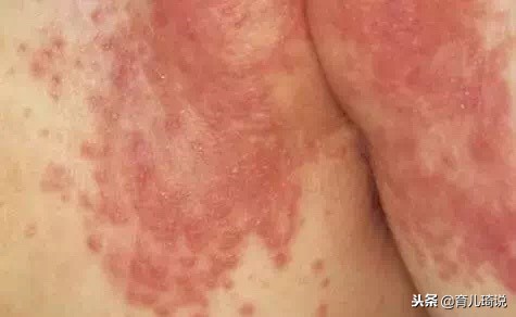 宝宝红屁股疼的直哭怎么办,宝宝红屁股的最佳治疗方法