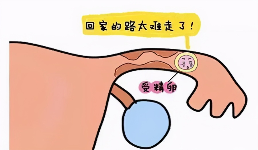 输卵管性不孕应该如何治,女性输卵管病变不孕不育的原因