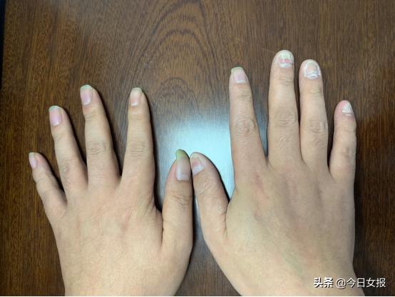 20岁男子双手脱皮还长了灰指甲，竟因爱抠脚的坏习惯！网友：细菌太厉害