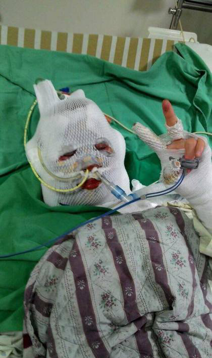 24岁正妹护理师因毁容曾想自杀，但现在立志重生回归