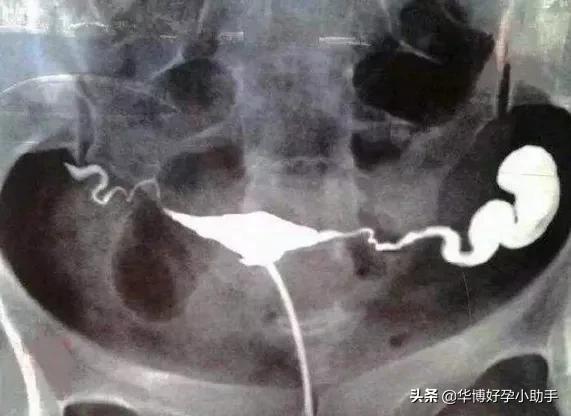 输卵管积水堵塞积水会倒流吗,积水为什么要切除输卵管