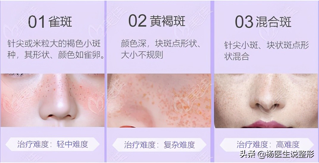 遗传性雀斑几岁可以激光祛斑,激光祛斑能不能根治雀斑