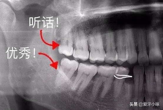 智齿经常疼痛到底要不要拔掉,智齿反复疼痛到底要不要拔掉