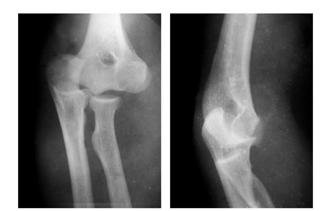 青少年肘部损伤最常见的是,肘部桡神经损伤的临床表现