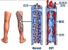 名医专访|深圳市罗湖区人民医院黄智勇：什么是深静脉血栓？
