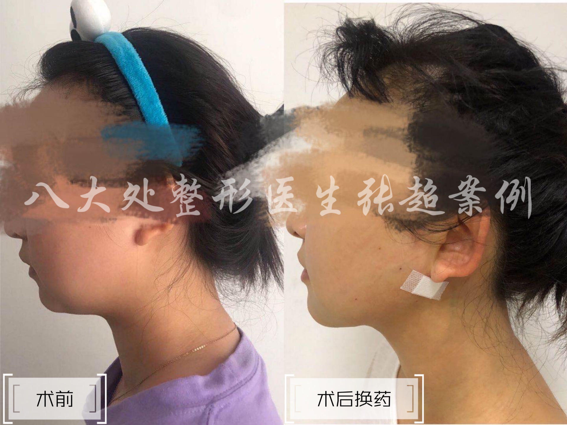 八大处整形张超,八大处张超最新视频