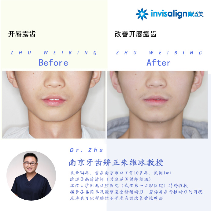 口腔正畸隐适美隐形矫治技术,隐适美深覆合矫正