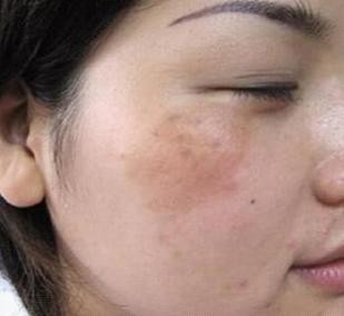 脸上长斑是激光还是用祛斑产品好,50岁年龄脸上长斑怎样能祛斑