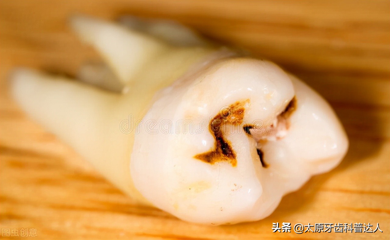 龋坏的牙齿自己掉后能补吗,5岁小孩牙齿龋坏了治疗费用