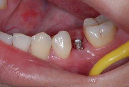 科普知识种植牙和烤瓷牙要怎么选,浦东新区烤瓷牙和种植牙哪种好