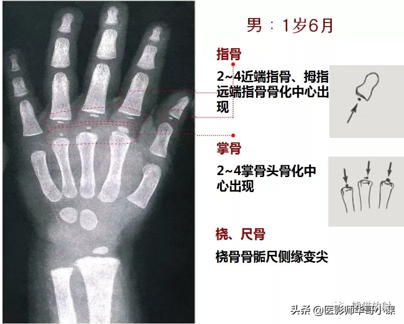 骨龄片对照图谱测骨龄准不,骨龄14岁男孩骨龄图谱