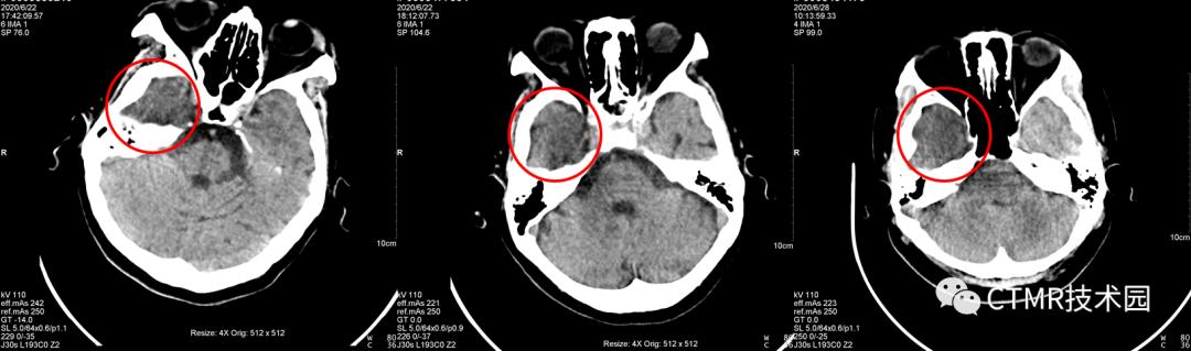 CT影像技术,脑部做ct有伪影是怎么回事