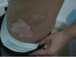 10年白癜风还能治吗,10年白癜风现原形