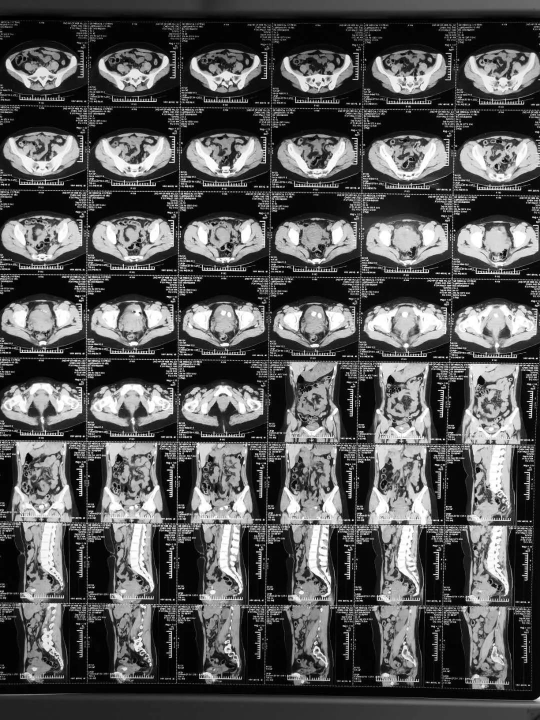 腹腔镜手术取节育环,节育环取出手术