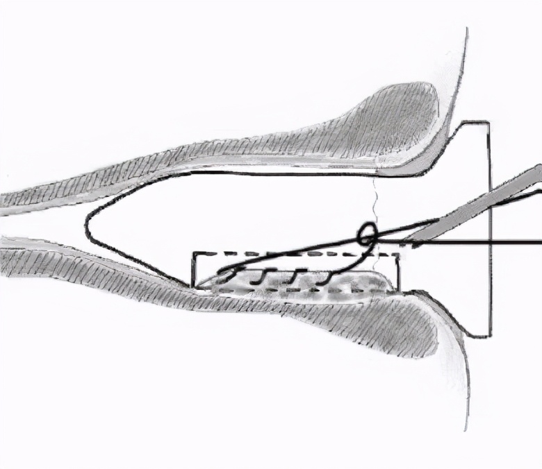 痔疮手术当天去医院就能做吗,两天后能出院的痔疮手术
