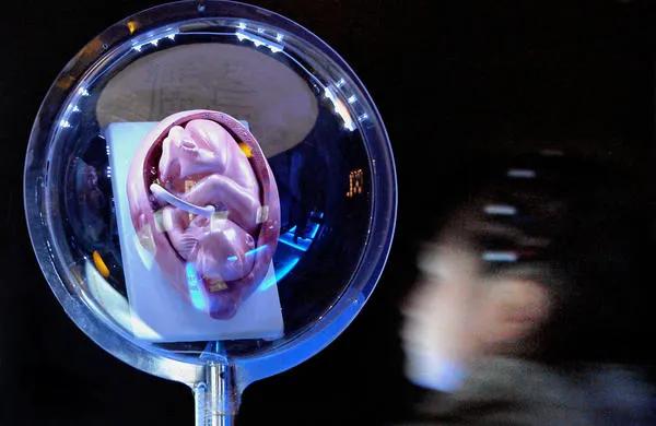 遗忘在妈妈身体里的节育环,妈妈身体里的节育环