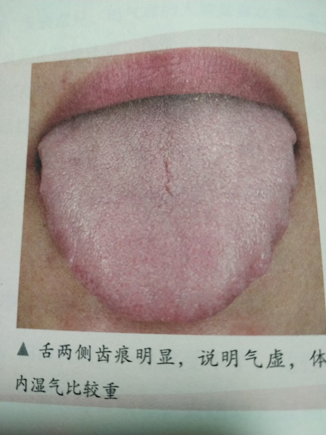 气虚体质补气易疲倦,气虚出汗气短易感冒