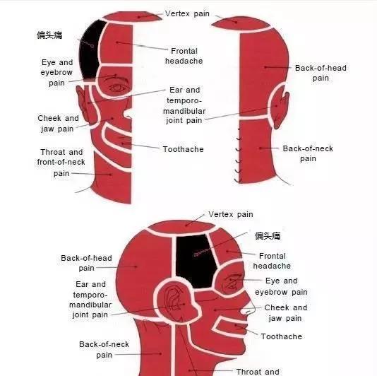 偏头痛的部位是哪里,偏头痛的原始痛点