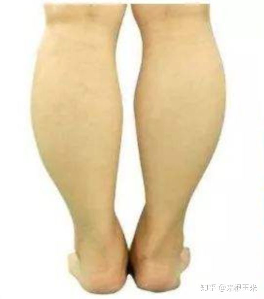水肿腿加大象腿怎么瘦,大象腿赘肉多