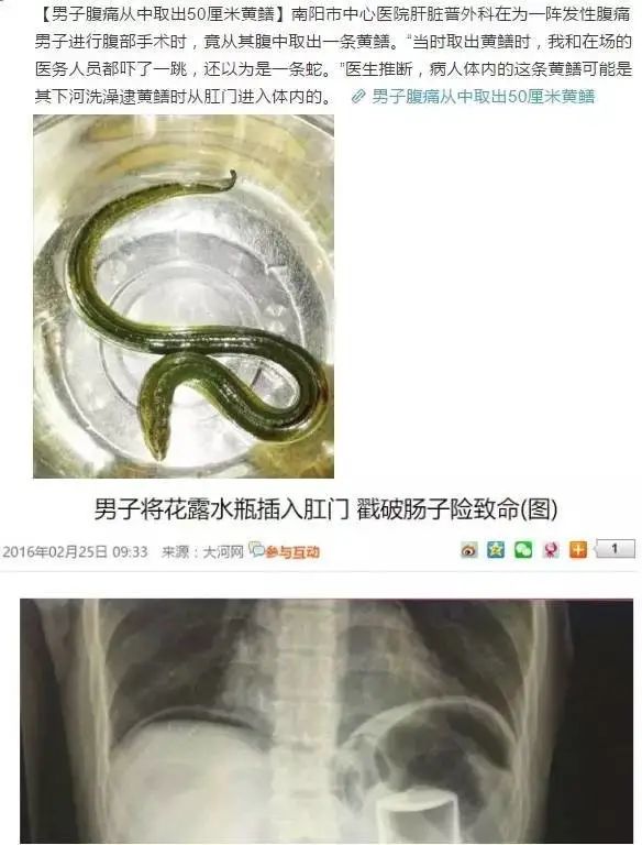 进去容易出来难：直肠异物，问题比“丢人”严重得多