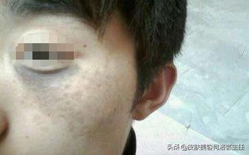 脸上有色斑应该怎么调理,脸上斑越来越多原因及治疗方法