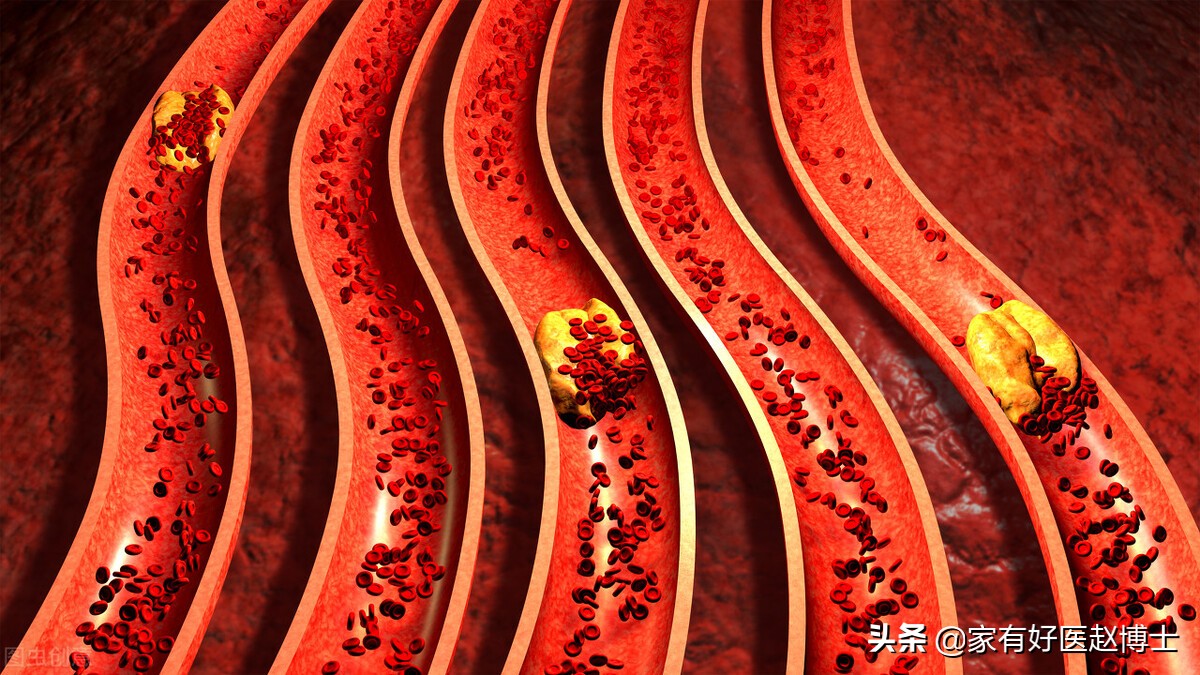 减缓血管老化做好以下几点,老人血管老化可以吃安宫牛黄丸吗