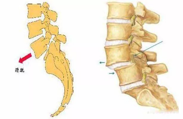 腰椎滑脱坐姿和站姿要注意吗,腰椎滑脱手术拆线后注意事项