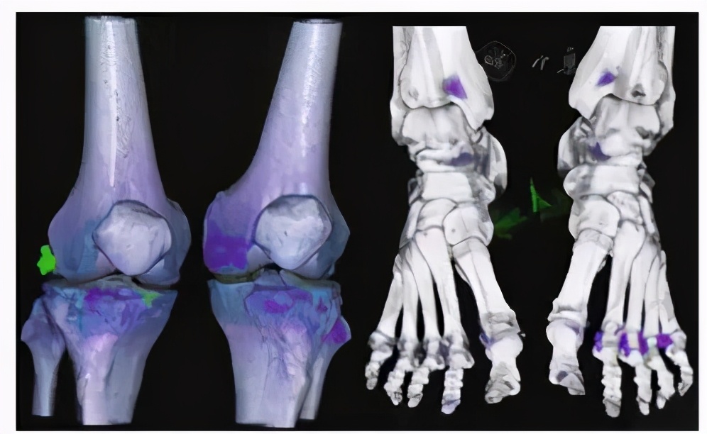 风湿关节痛和痛风是一样的吗,大关节痛是痛风还是类风湿