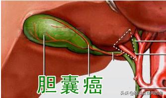 消化系统癌症都有哪些？你知道怎样预防吗？