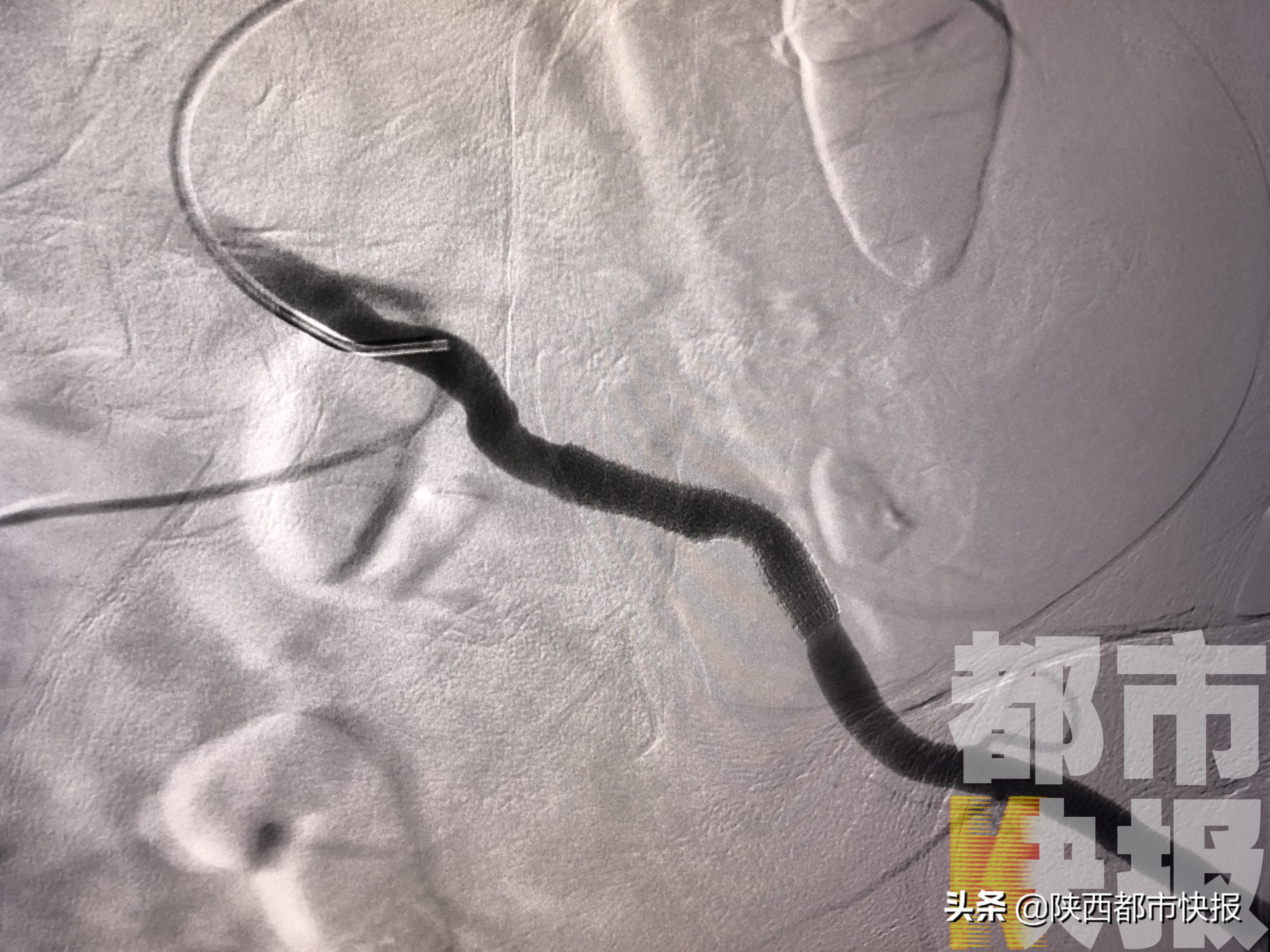 男子动脉破裂大量出血被交警救助,男子股动脉破裂大出血