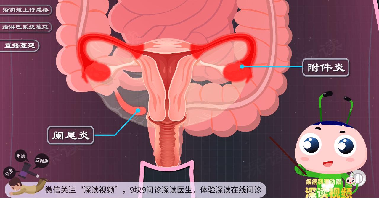 妇科附件炎最佳治疗方法,人流后附件炎是怎么引起的