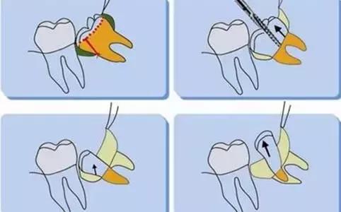 水平阻生智齿一定要拔掉吗,嘴里长了智齿一定要拔掉吗