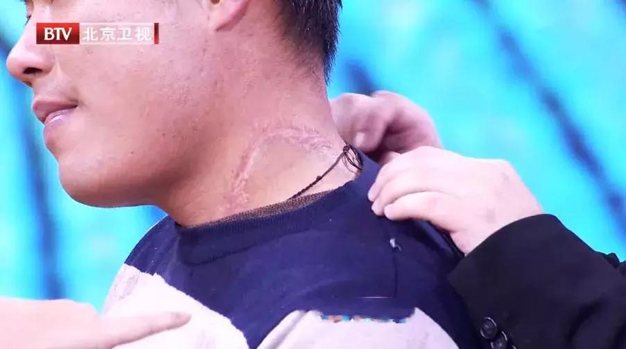 甲亢为什么会出现心慌手抖的症状,甲亢心悸心慌是严重了吗