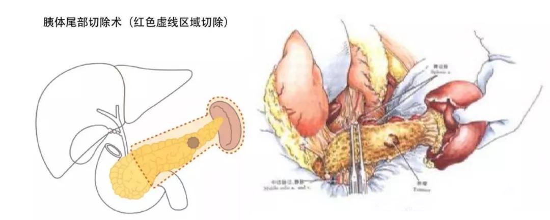 早期易忽视，发现即晚期，治疗效果差，胰腺癌为什么这么难？