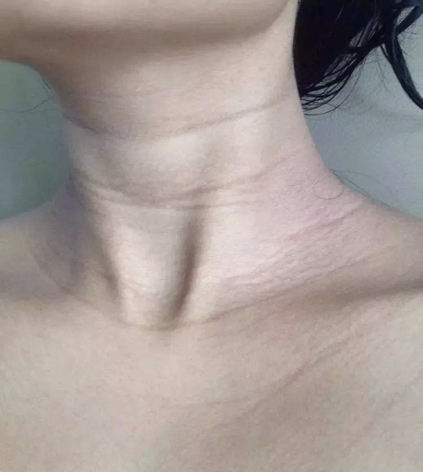 脖子上的颈纹怎么锻炼才能淡化,去脖子颈纹最好的方法真实有效