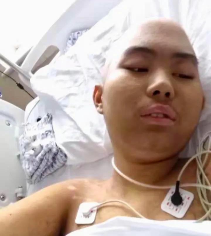 移植后肠排异要禁食多久,移植后排异严重禁食