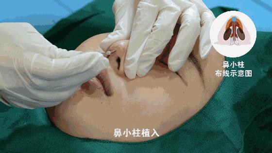 为什么不建议做线雕手术,为什么不推荐做线雕鼻