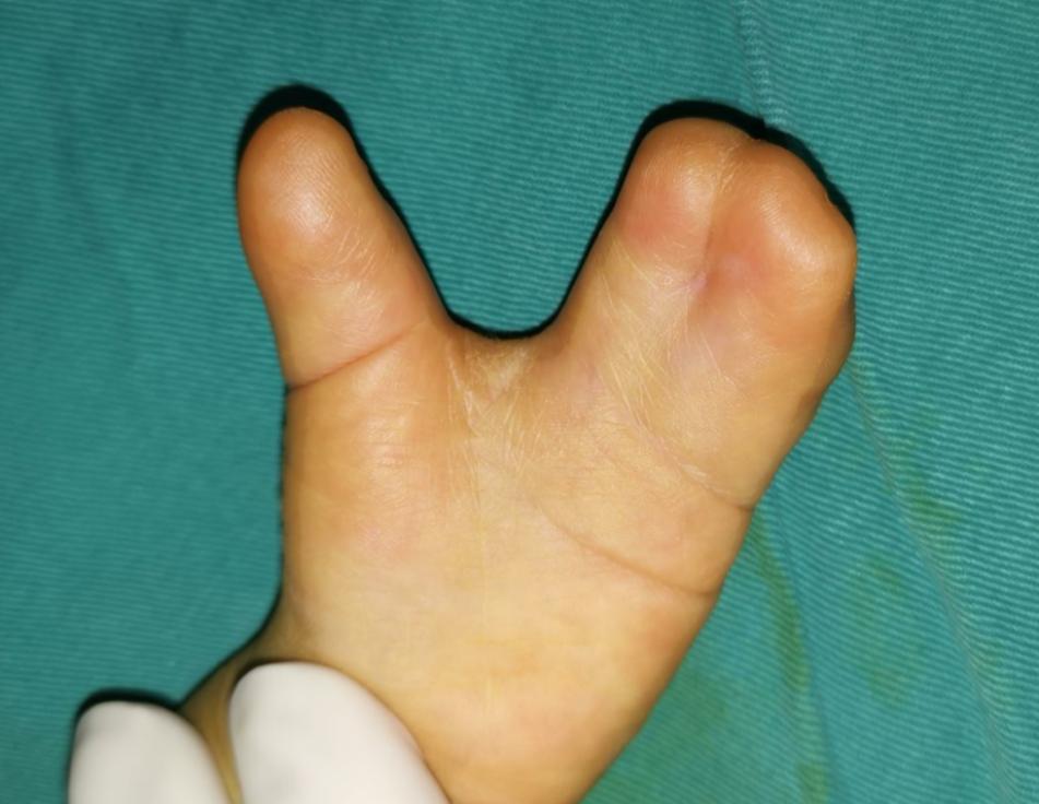 并指畸形免植皮案例,并指畸形