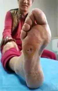 糖尿病脚底疼是不是并发症,糖尿病并发症脚底脱皮严重