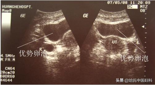 多囊卵巢综合征怀孕多久能测出来,多囊卵巢综合征怀孕了容易流产吗