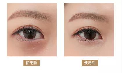 眼睛黑眼圈显老怎么办,眼睛黑眼圈大眼袋怎么消除